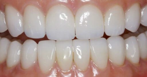 after cosmetic dentistry