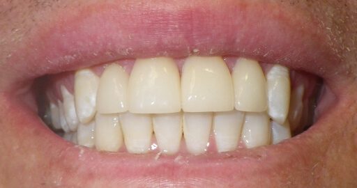 after teeth straightening