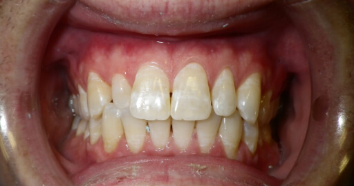 before and after image of family dentistry services
