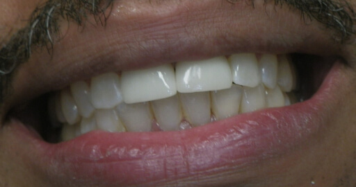 after orthodontics