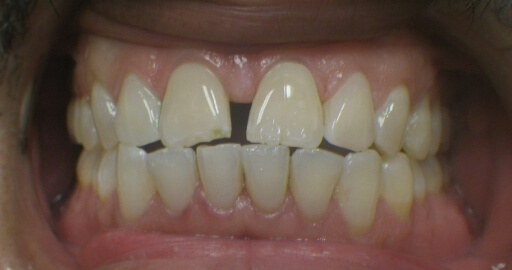 before orthodontics